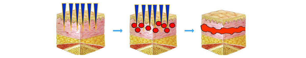 Collagen Induction Therapy (CIT) by Micro-needling