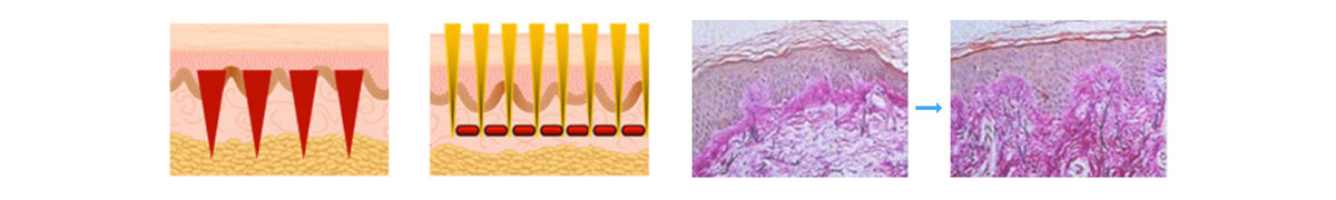 Wound Healing Mechanism (WHM) by RF Energy